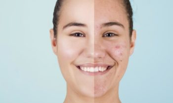 Is it Necessary to Treat Acne?