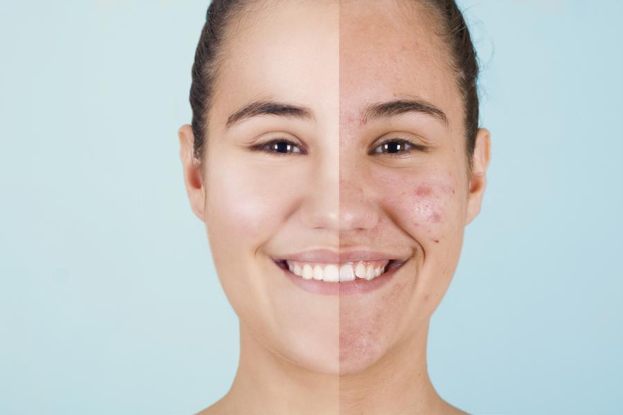 Is it Necessary to Treat Acne?